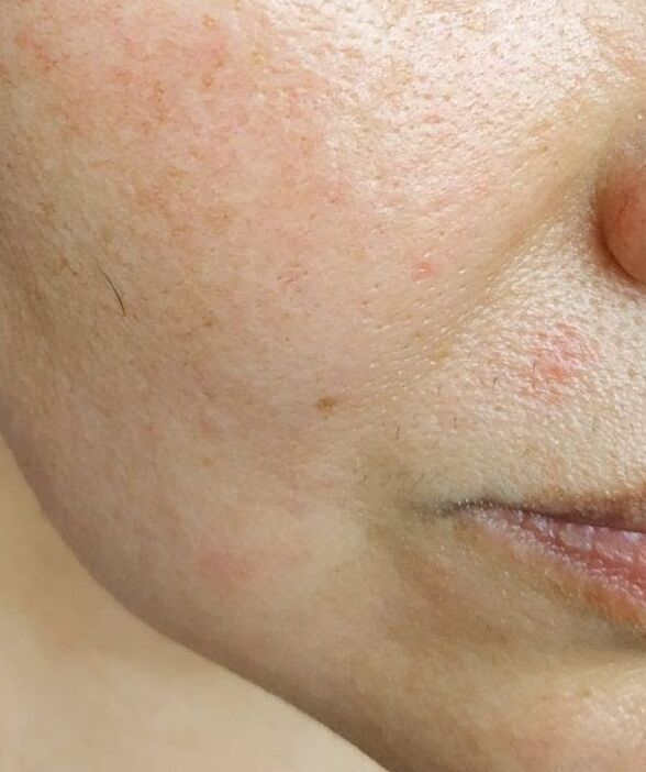 Intenskin s'est débarrassé des plis nasolabiaux profonds