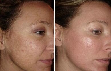 rajeunissement du visage au laser photos avant et après